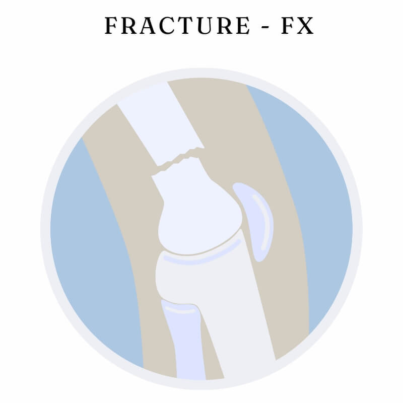 Fracture - FX