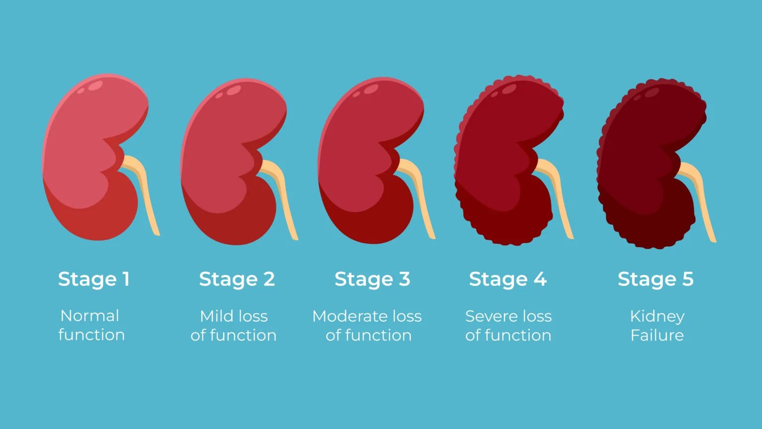 The 5 Stages of Kidney Disease and What They Mean for Life Expectancy ...